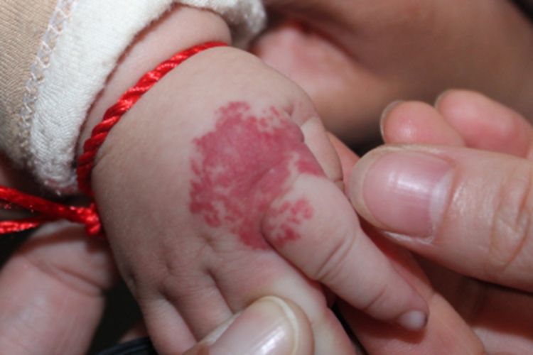 血管瘤手上有红色瘀血图