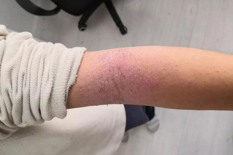 特应性皮炎图 特应性皮炎图