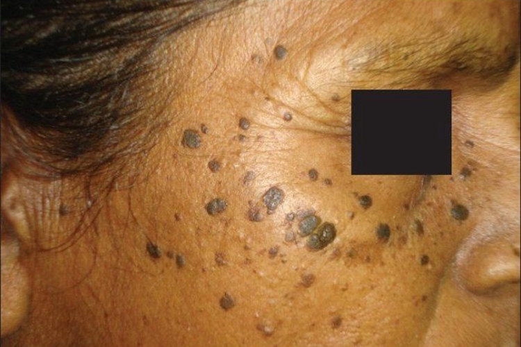 脂溢性角化病面部症状图