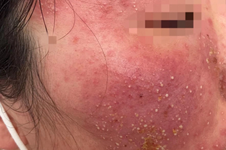 糖皮质激素依赖性皮炎白头粉刺图 糖皮质激素依赖性皮炎白头粉刺图