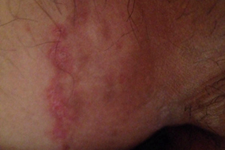 艾滋病非感染性皮肤损害大腿红斑图