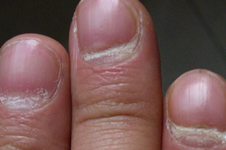 银屑病甲指甲有横沟图