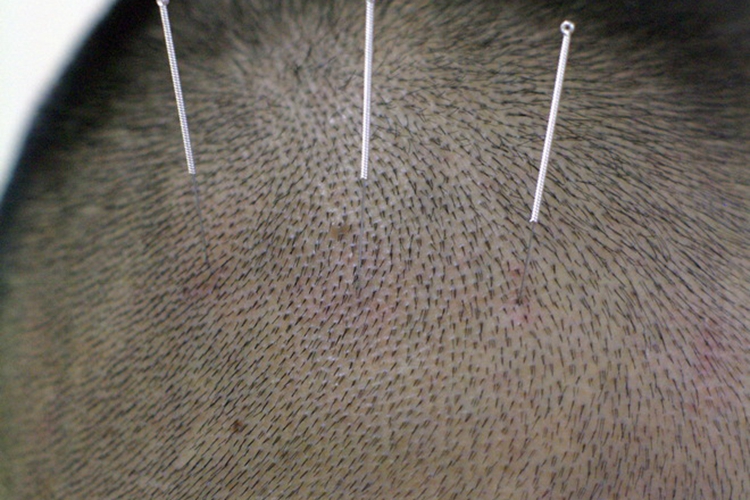 颞三针的准确位置图