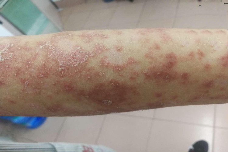 泛发性脓疱型银屑病胳膊结痂图