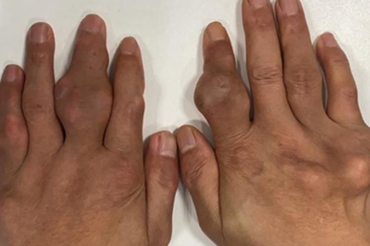 痛风性关节炎疙瘩图