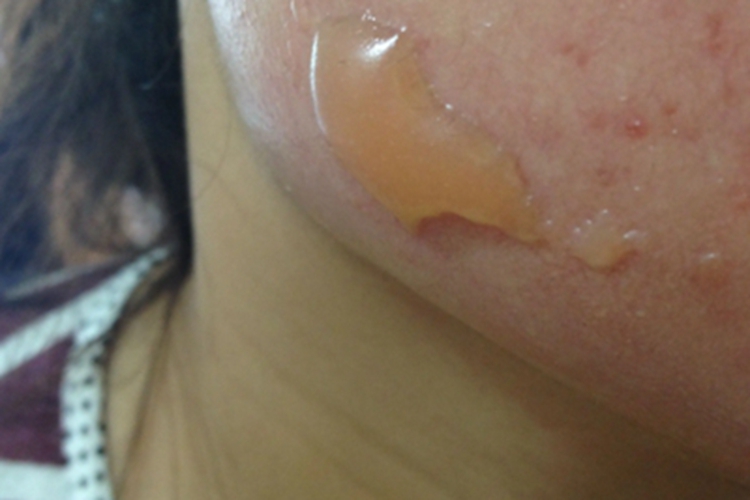 日光性皮炎面部症状图 日光性皮炎面部症状图