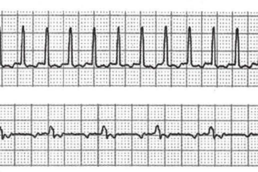 局灶性房性心动过速图 局灶性房性心动过速图