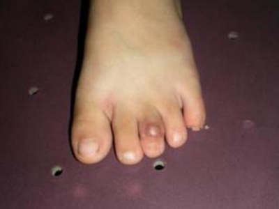 掌跖纤维瘤病脚趾头上有个结节图.jpg