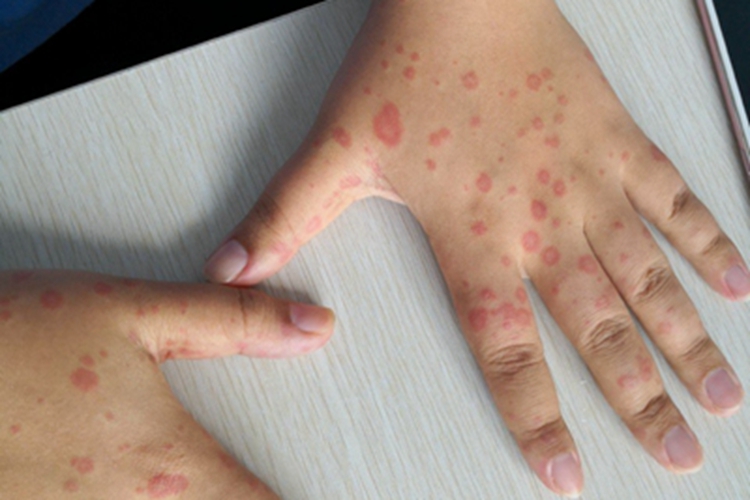 多形红斑型药疹红斑图