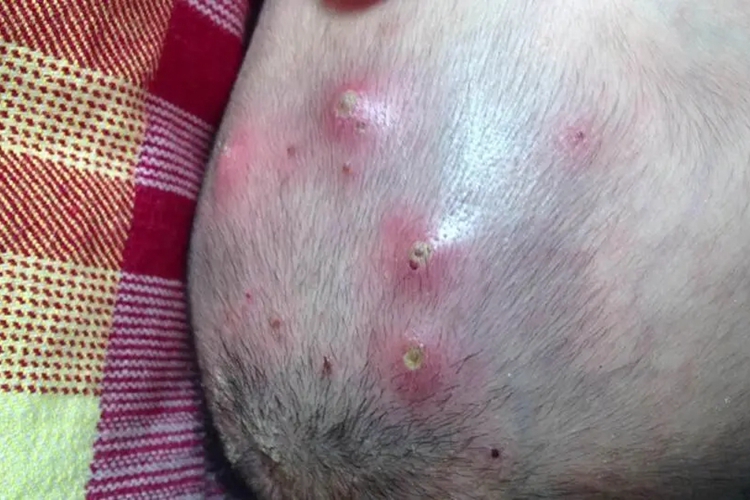 婴儿头顶出现黄脓包图片