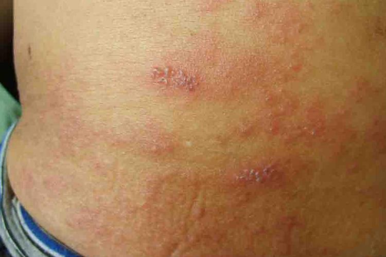 腰骶部蛇盘疮初期图