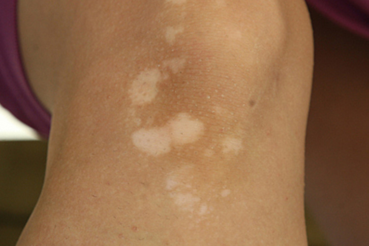 白癜风下肢圆形白斑图