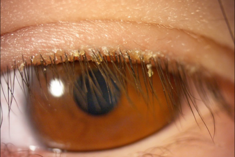 眼睛有螨虫症状图