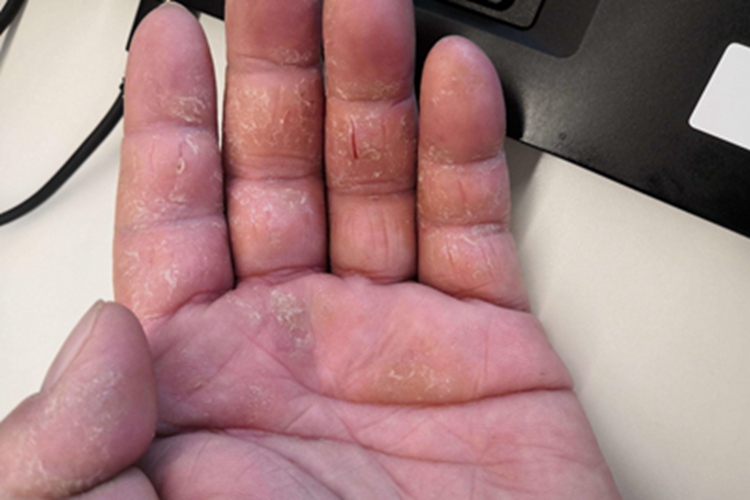 皲裂性湿疹手部脱皮有裂痕图