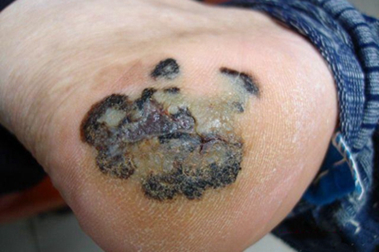 恶性黑色素瘤脚底症状图