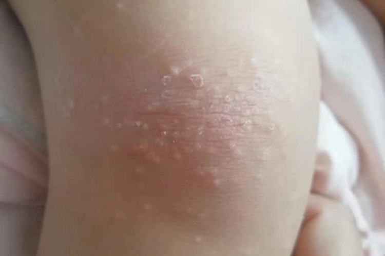 摩擦性苔藓样疹脱屑图