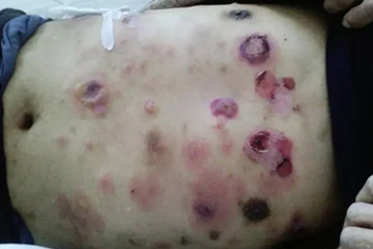 副肿瘤性天疱疮腹部糜烂图