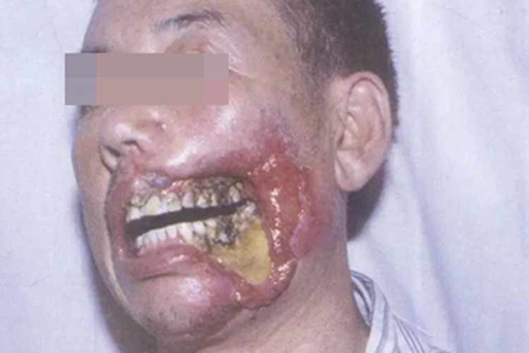 电烧伤面部症状图