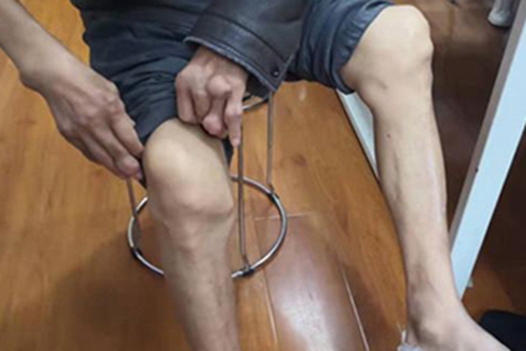 痛风膝盖症状图 痛风膝盖症状图