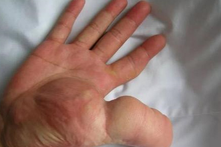 大拇指脂肪瘤图