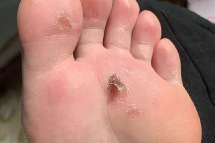 寻常疣脚底长硬疙瘩还起皮图 寻常疣脚底长硬疙瘩还起皮图