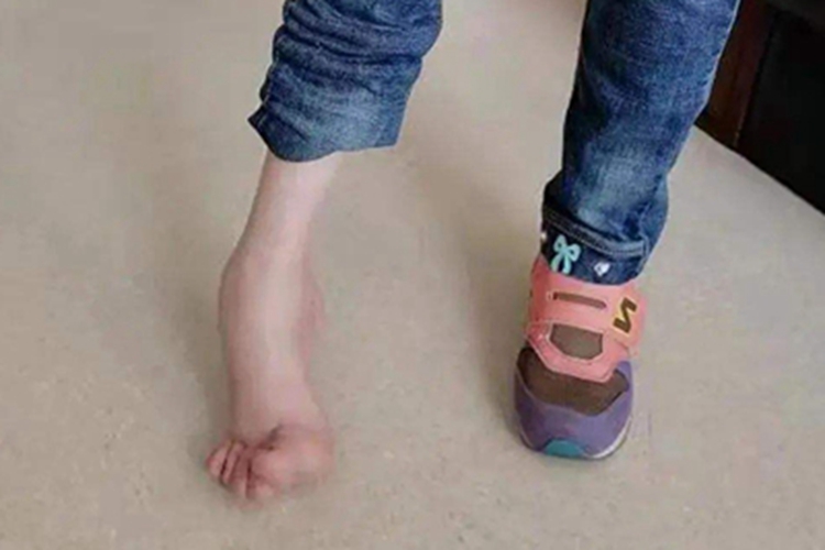 成骨不全右脚畸形图