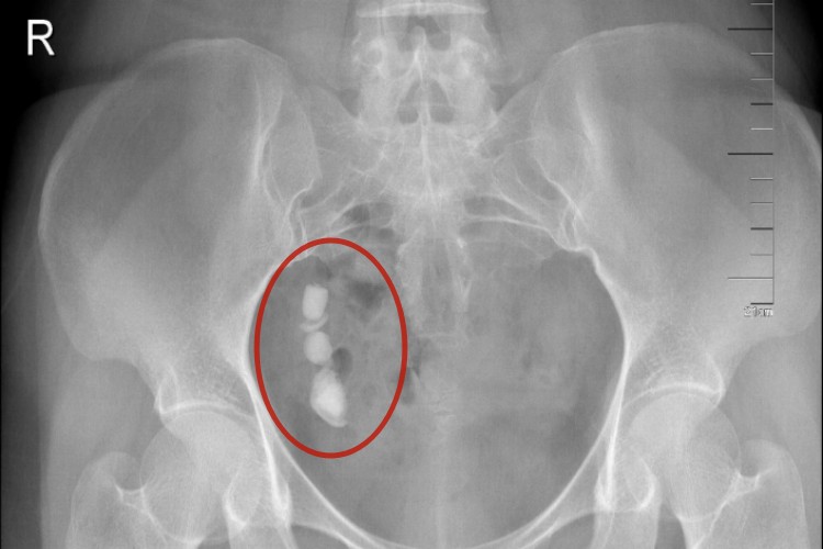 输尿管片状结石影像图