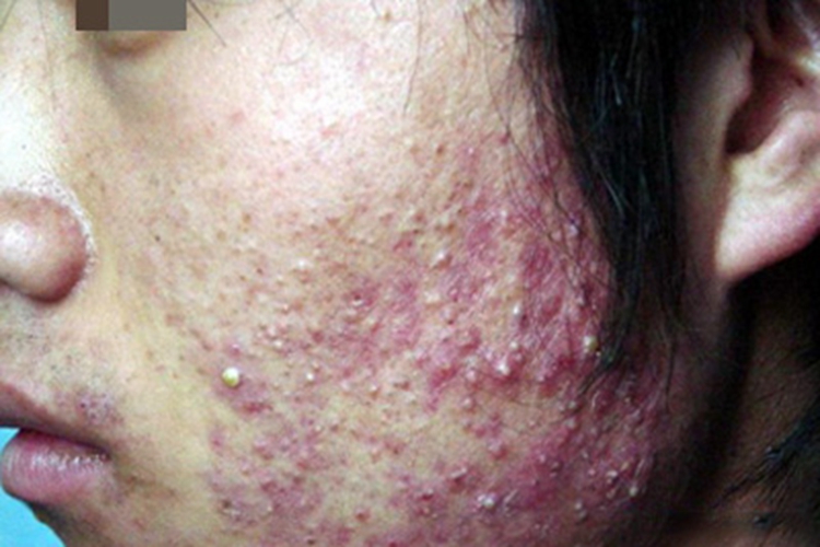 痤疮面部长疙瘩有脓头图