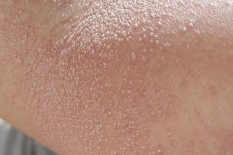 日光性皮炎疙瘩图