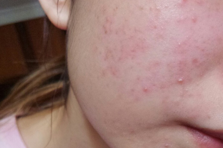 真菌过敏性皮炎图