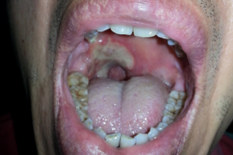 扁桃体旁边有溃疡图