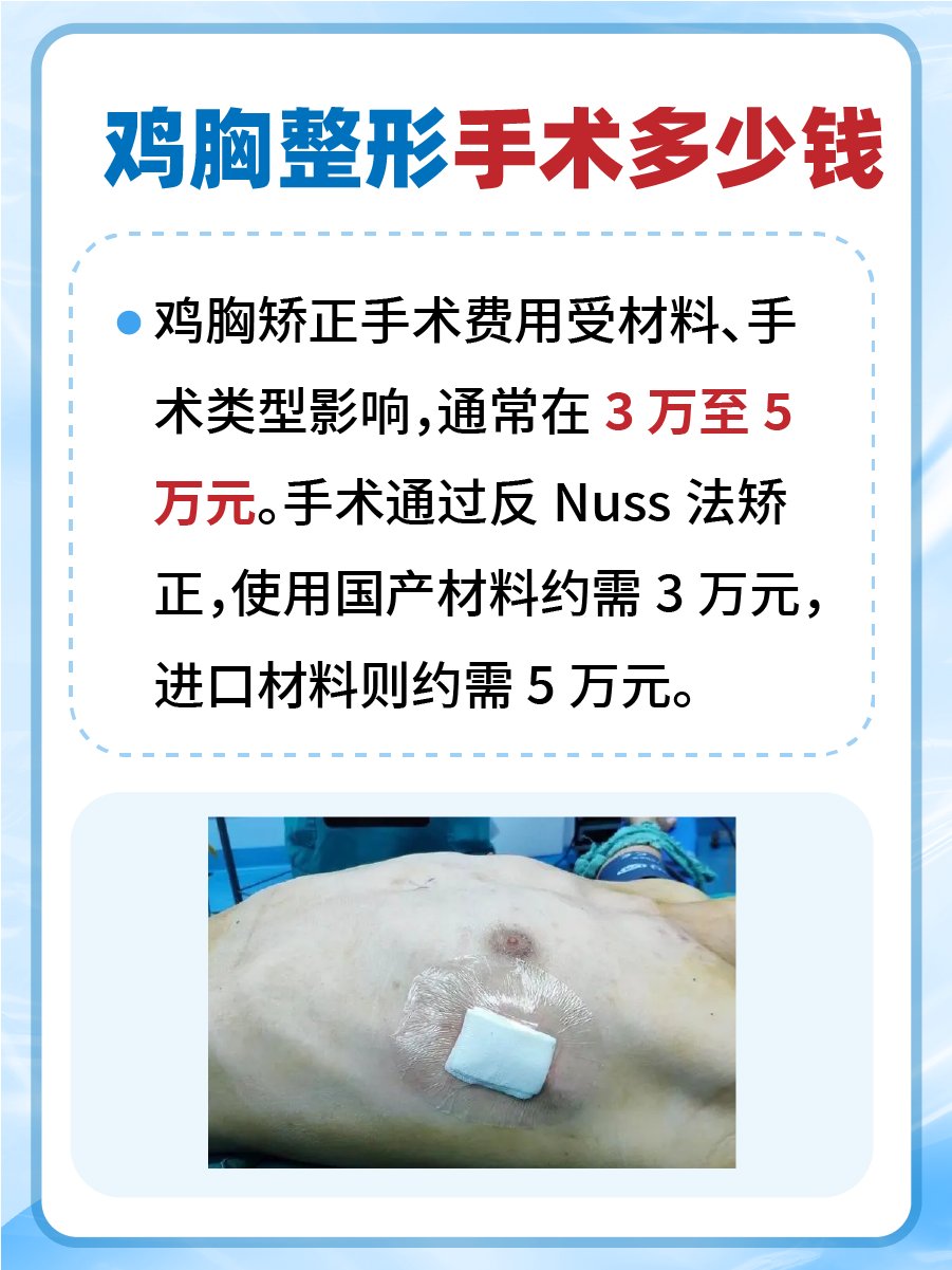 鸡胸整形手术费用，看完不再迷茫！