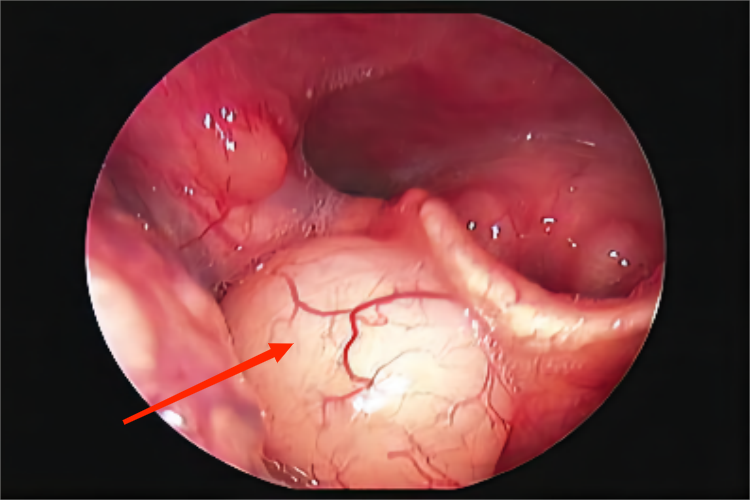 过敏喉头水肿图