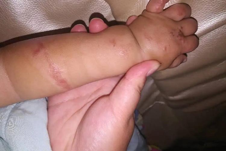 开水烫伤康复期图