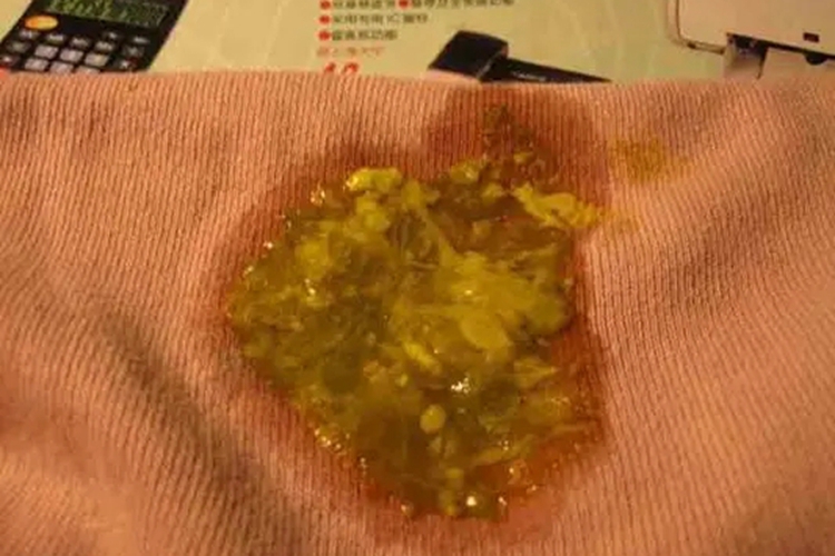 4个月宝宝溃疡性结肠炎图