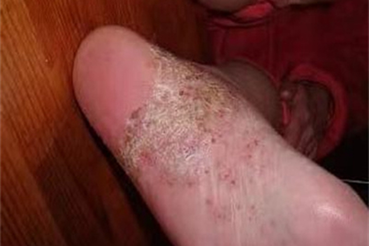 局限性脓疱型银屑病结痂图 局限性脓疱型银屑病结痂图