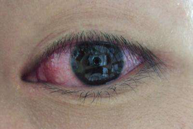 眼睑淋病结膜红肿图