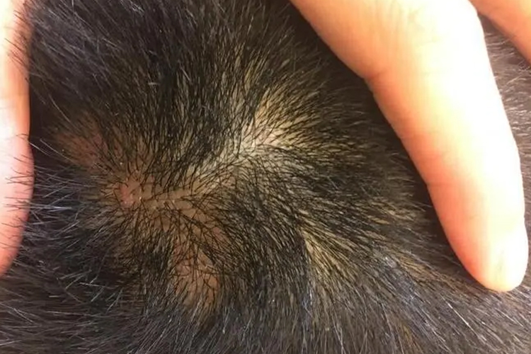 儿童头皮上有皮脂腺痣图