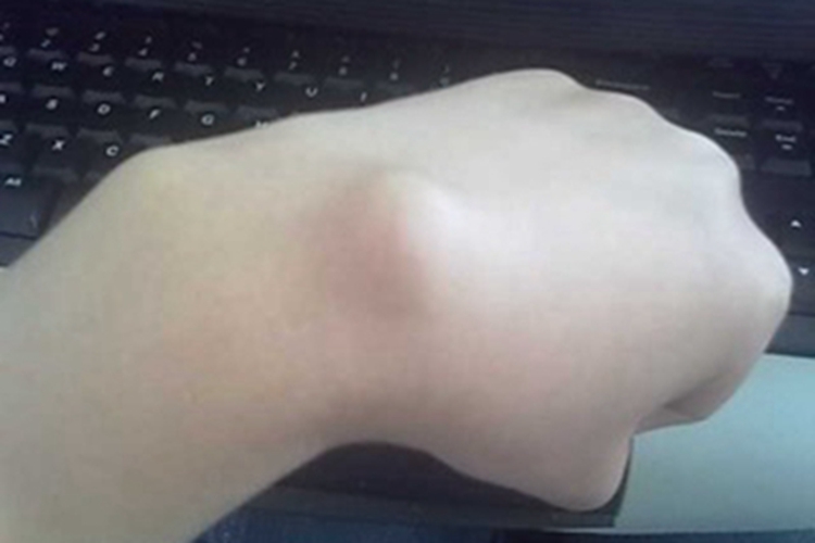 腱鞘囊肿手背症状图