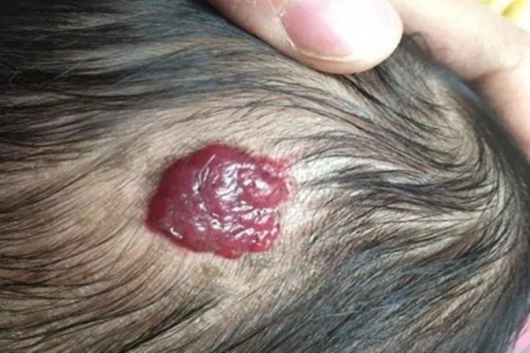 浅表型婴儿血管瘤图 浅表型婴儿血管瘤图