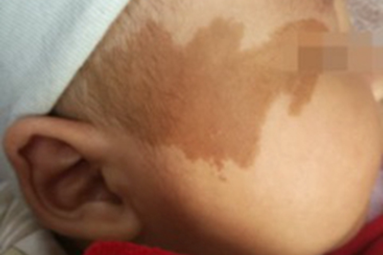 咖啡斑脸上长大片棕色斑块图