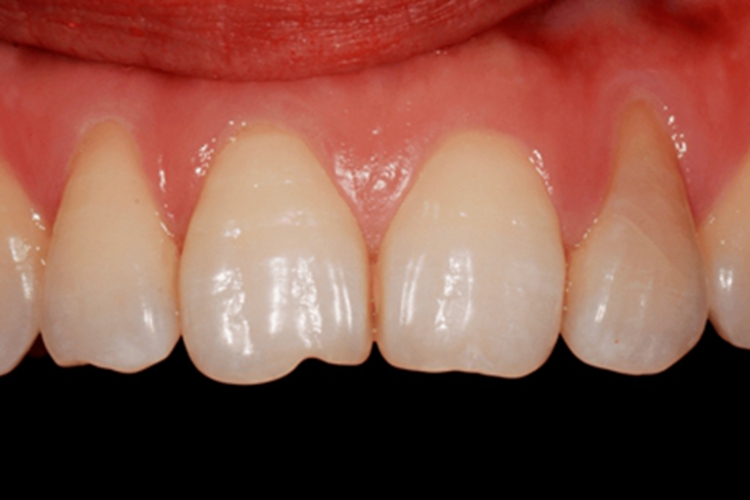 牙龈萎缩牙根有轻微漏出图