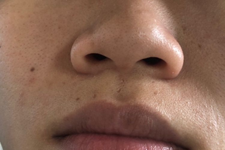 黑头鼻尖米粒小刺图