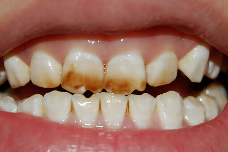 釉质发育不全图 釉质发育不全图