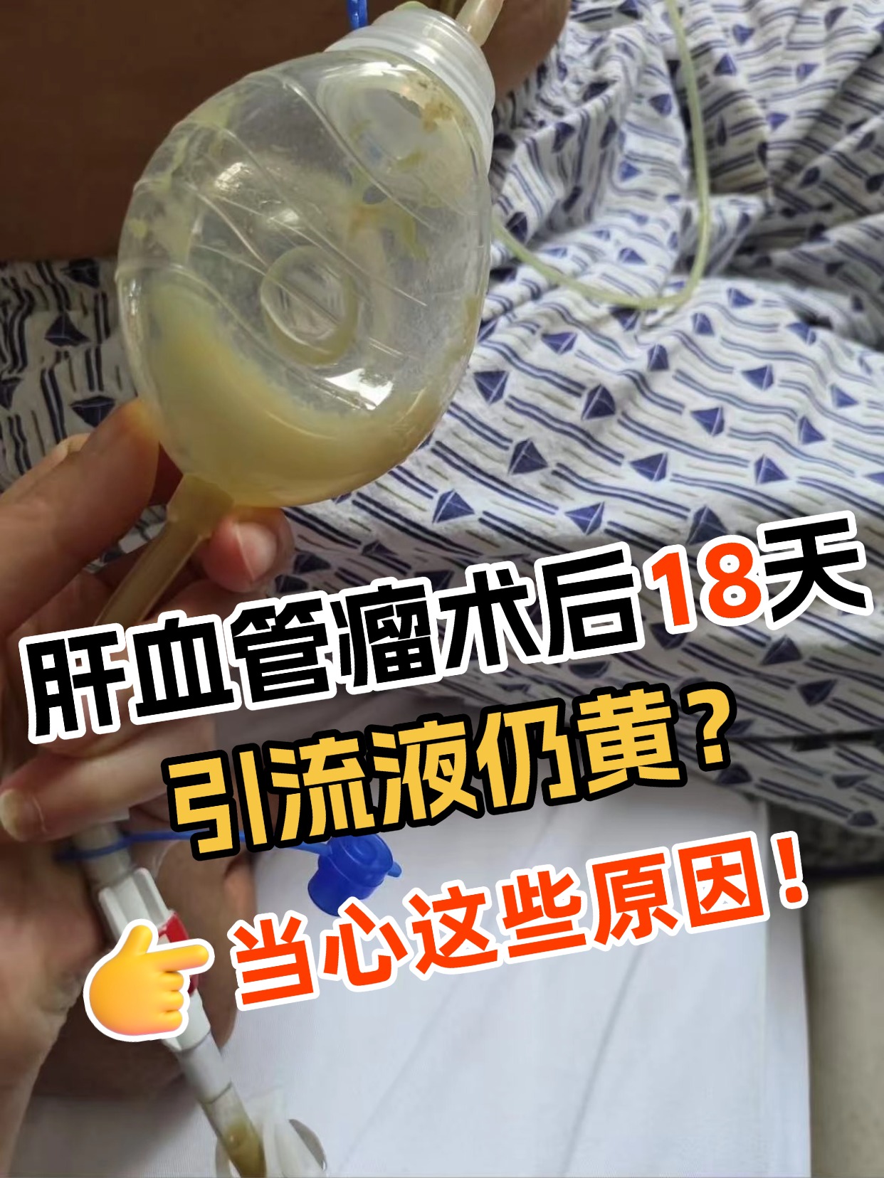 肝血管瘤术后18天引流液仍黄？当心这些原因！