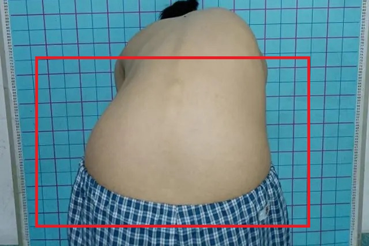 青少年特发性脊柱侧弯腰部症状图