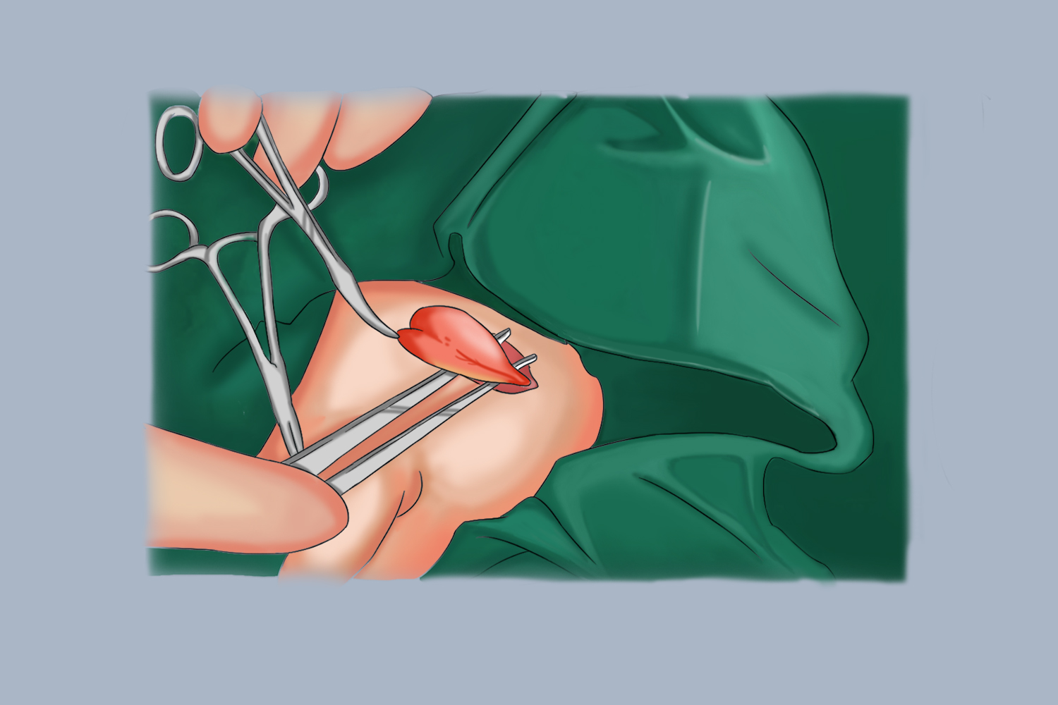 男宝宝精索鞘膜积液图