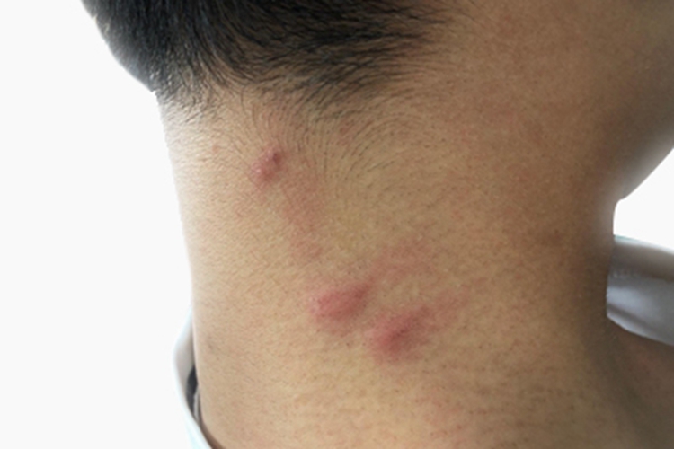 丘疹性荨麻疹后颈疙瘩图 丘疹性荨麻疹后颈疙瘩图