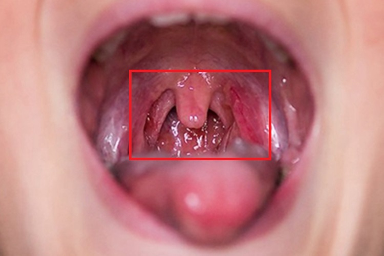 急性咽炎红肿图 急性咽炎红肿图