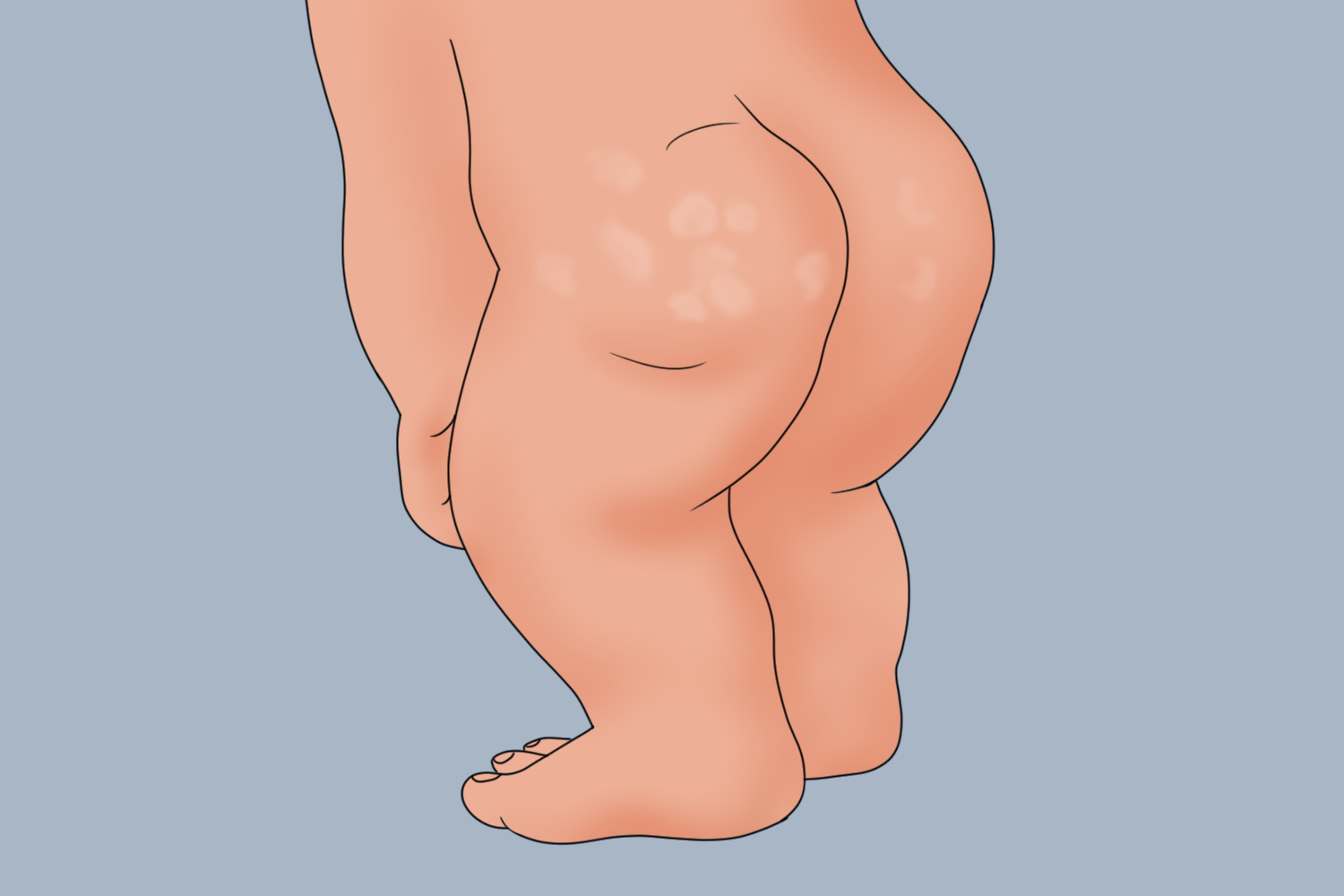 屁股上白色花斑糠疹图